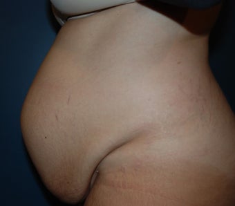 Tummy Tuck 1270672