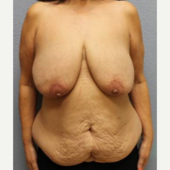 45-54 year old woman treated with Mommy Makeover before 3423931