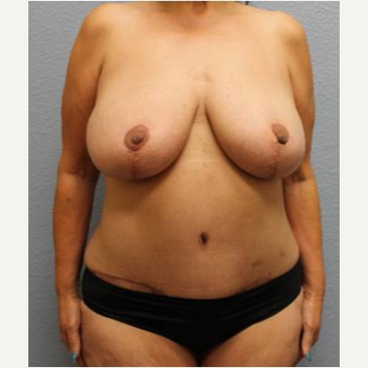 45-54 year old woman treated with Mommy Makeover after 3423931