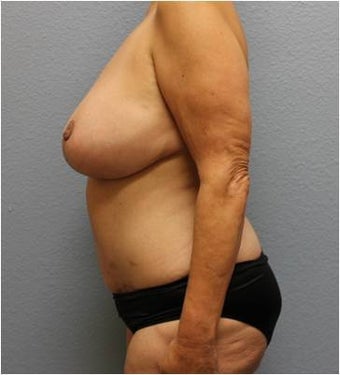 45-54 year old woman treated with Mommy Makeover 3423931