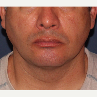 35-44 year old man treated with ThermiTight after 3138920