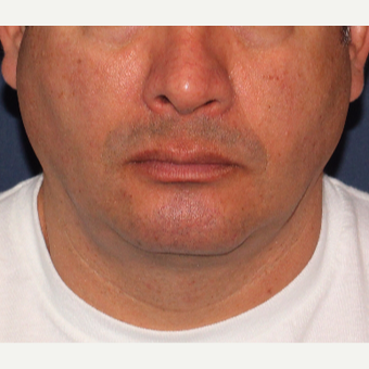 35-44 year old man treated with ThermiTight before 3138920