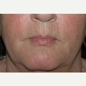 52 year old woman treated with Dermabrasion before 3710969