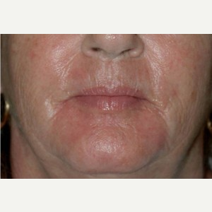52 year old woman treated with Dermabrasion after 3710969