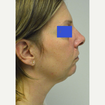 45-54 year old woman treated with Kybella before 3224979