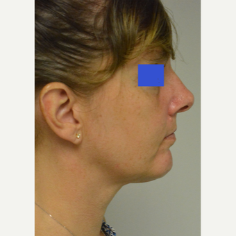 45-54 year old woman treated with Kybella after 3224979