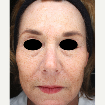 45-54 year old woman treated with IPL before 3783818