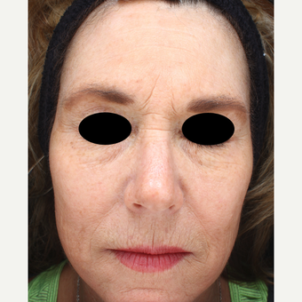 45-54 year old woman treated with IPL after 3783818