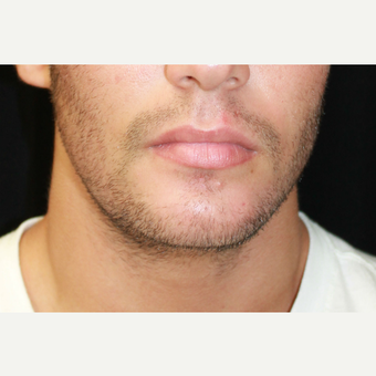 18-24 year old man treated with Chin Implant and Jaw angle implants before 3741951