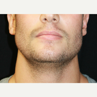18-24 year old man treated with Chin Implant and Jaw angle implants after 3741951