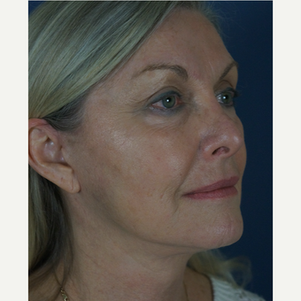55-64 year old woman treated with Mini Lift after 1816321