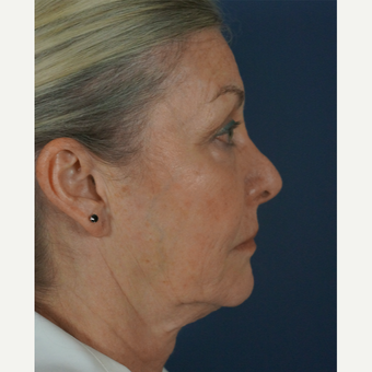55-64 year old woman treated with Mini Lift 1816321