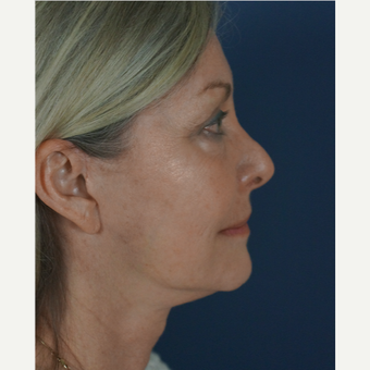 55-64 year old woman treated with Mini Lift 1816321