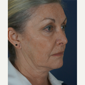 55-64 year old woman treated with Mini Lift before 1816321