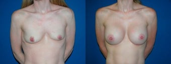 39 year old woman treated with Breast Augmentation before 2990418