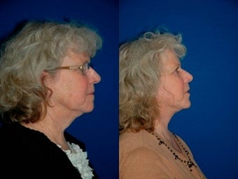 58 year old woman treated with Facelift before 3004837