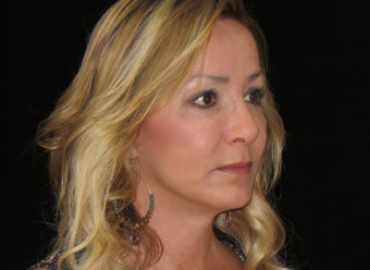 45-54 year old woman treated with Facelift, quad blepharoplasty 2509104
