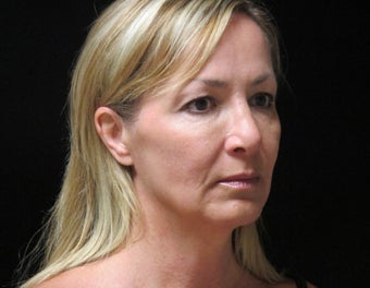 45-54 year old woman treated with Facelift, quad blepharoplasty 2509104