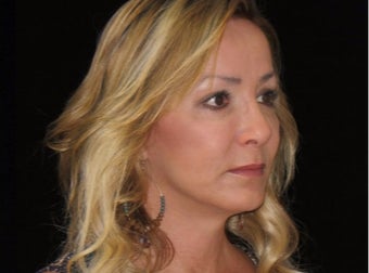 45-54 year old woman treated with Facelift, quad blepharoplasty after 2509104