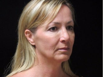 45-54 year old woman treated with Facelift, quad blepharoplasty before 2509104