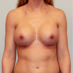 Breast Implants after 2081037