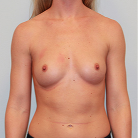 Breast Implants before 2081037