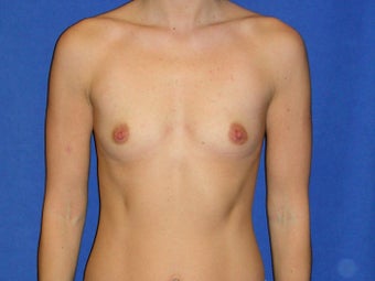 Breast Augmentation before 1189561