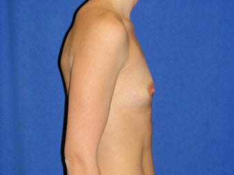 Breast Augmentation 1189561