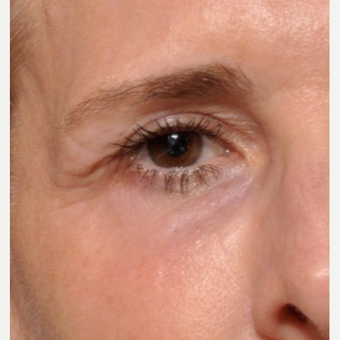 Say Goodbye to Those Fine Lines Around the Eyes after 3793614