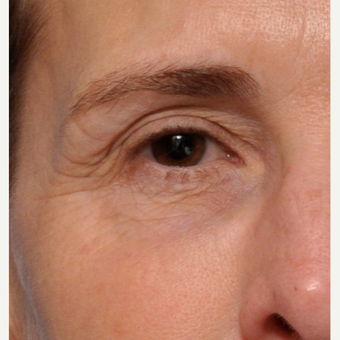 Say Goodbye to Those Fine Lines Around the Eyes before 3793614
