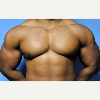 Bilateral Gynecomastia Correction after 2969828