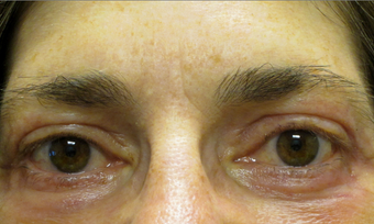 55 year old woman treated for droopy eyelid and eyelid bags after 853588