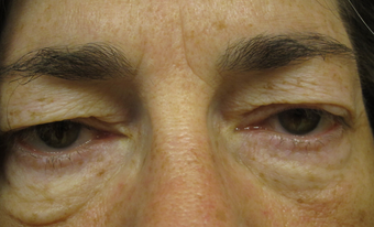 55 year old woman treated for droopy eyelid and eyelid bags before 853588