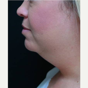 25-34 year old woman treated with 1 CoolSculpting treatment before 3252920