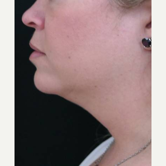25-34 year old woman treated with 1 CoolSculpting treatment after 3252920