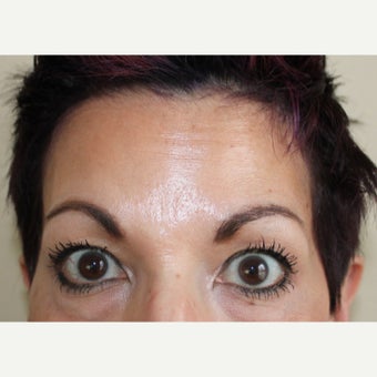 45-54 year old woman treated with Xeomin 1779779