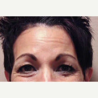 45-54 year old woman treated with Xeomin before 1779779