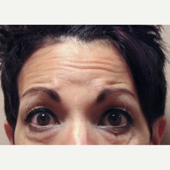 45-54 year old woman treated with Xeomin 1779779