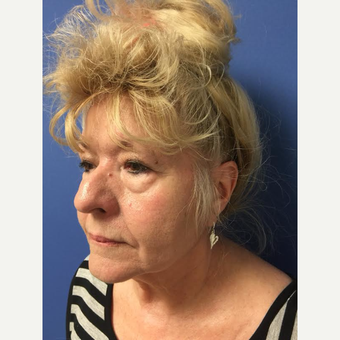 65-74 year old woman treated with Eyelid Surgery before 3684552