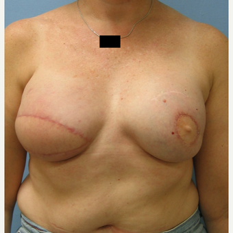 Breast Reconstruction with Latissimus Flap for this 55 Year Old Woman after 3088929