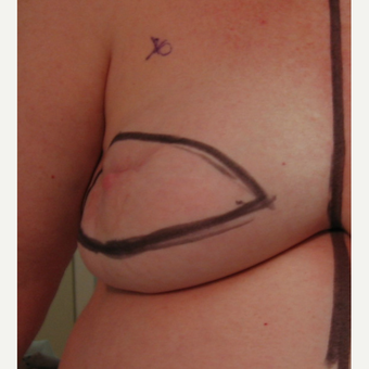 Breast Reconstruction with Latissimus Flap for this 55 Year Old Woman before 3088929