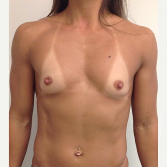 Breast Augmentation before 1652534