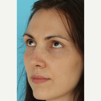 25-34 year old woman treated with Rhinoplasty after 3690817