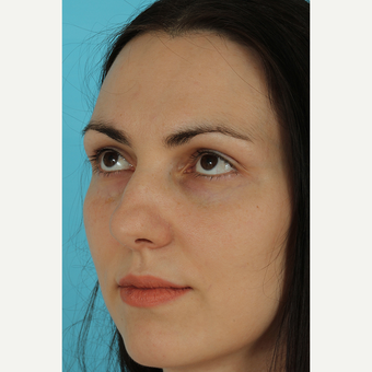 25-34 year old woman treated with Rhinoplasty before 3690817
