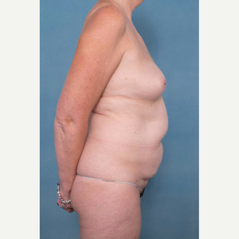 55-64 year old woman treated with Mommy Makeover before 3137347