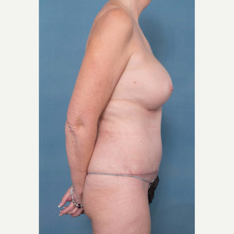 55-64 year old woman treated with Mommy Makeover after 3137347
