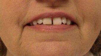 Radiesse before and after for Marionette Lines before 1125249