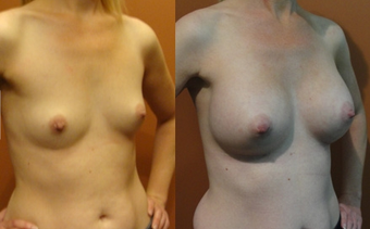 Breast Implants before 974269
