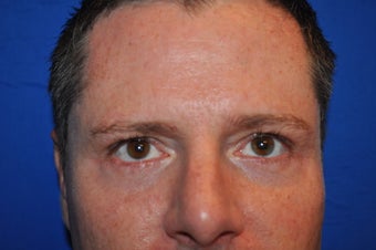 44 Year Old Male Lower Blepharoplasty to Eliminate Puffy Under-Eye Bags after 894603