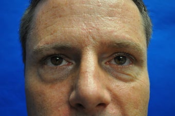44 Year Old Male Lower Blepharoplasty to Eliminate Puffy Under-Eye Bags before 894603